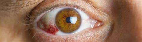 Zapalenie rogówki oka czym jest i jakie są objawy Vidium