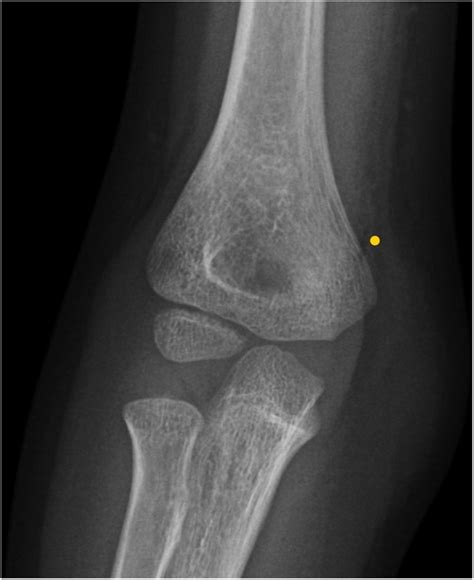 Child With Multiple Fractures A Rare Presentation Of A Common Disease