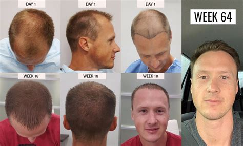 Hair transplant fue transplant hair new fue hair transplant equipment hair loss treatment. Hair Transplant in Mexico, Tijuana - FUE $3,800 | BBB ...