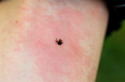 How Bug Bites Can Cause Bruises And How To Prevent Them Mosquitonix®