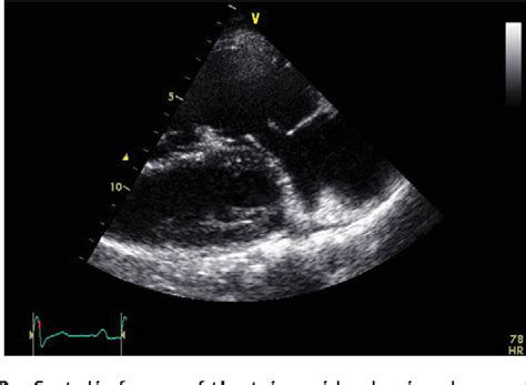 Figure 2 From Double Orifice Mitral Valve With Dysplastic Tricuspid