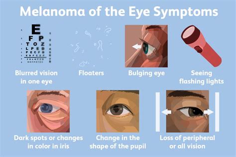 How To Prevent Identify And Treat Melanoma Of The Eye