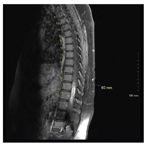 Postoperative Mri Of The Thoracic Spine With Contrast Postoperative