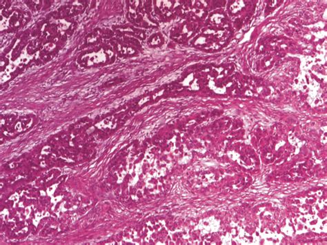 Acantholytic Squamous Cell Carcinoma With Many Acantholytic Cells And