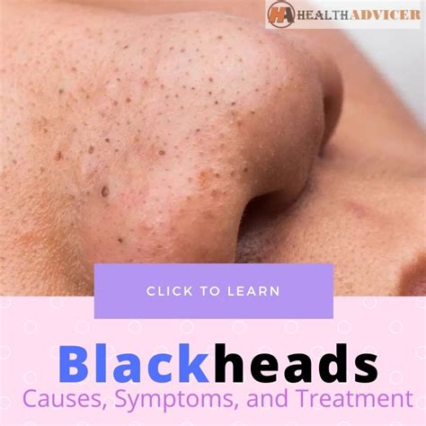 Blackheads Causes Symptoms Diagnosis And Treatment