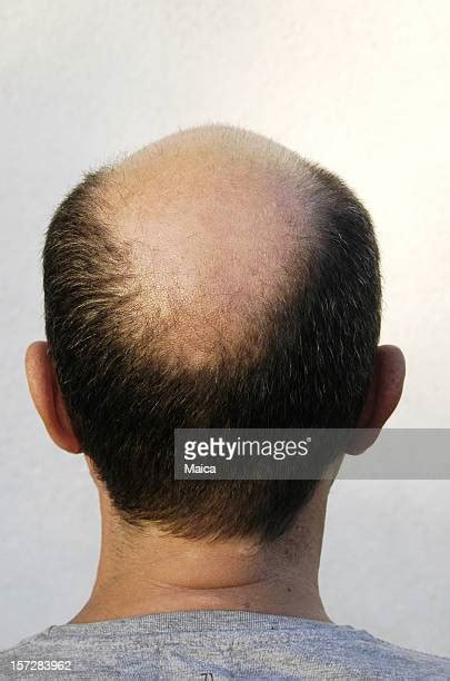 Back Of Balding Head Photos And Premium High Res Pictures Getty Images