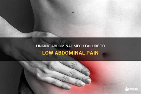 Linking Abdominal Mesh Failure To Low Abdominal Pain Medshun