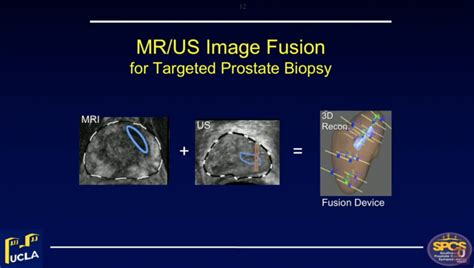Mrius Fusion Prostate Biopsy Leonard S Marks Md