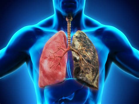 Is Asthma A Pulmonary Disease