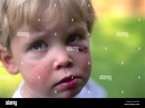 Child Bruised Face
