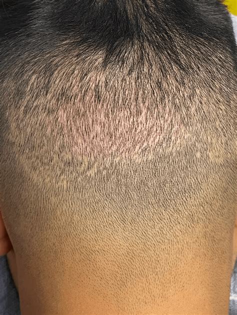 Scars From Hair Transplants