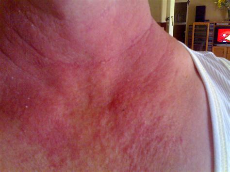 Itchy Neck Rash Pictures Photos