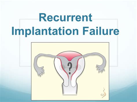 New Treatment Option For Recurrent Implantation Failure On The Horizon Short Term Copper Iud
