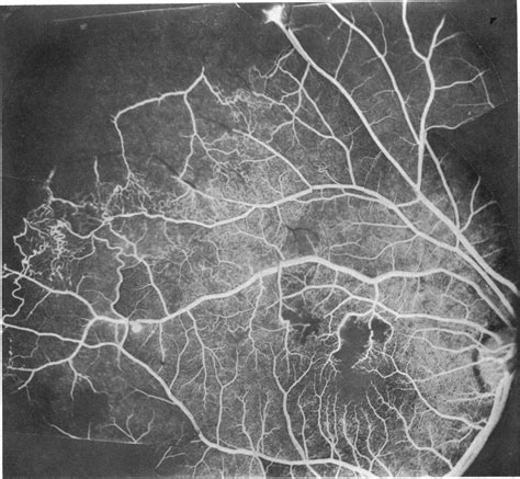 Case I Fluorescein Angiogram Of Right Fundus 48 Hours After