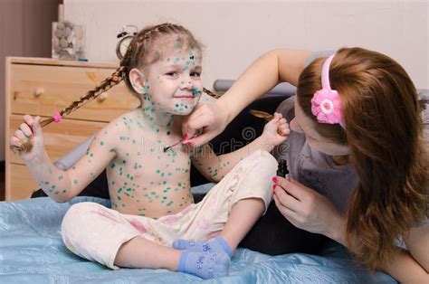Mom Misses Zelenkoj Chickenpox Rash On Chest Of Child