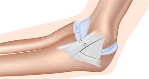 Medial Elbow Ligament Sprain Symptoms Causes Treatment And Rehab
