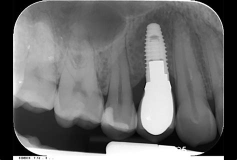 Retrospective Analysis Of The Survival Of Dental Implants Placed By