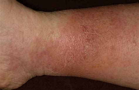 Stasis Dermatitis Pictures Symptoms Causes Treatment Diagnosis