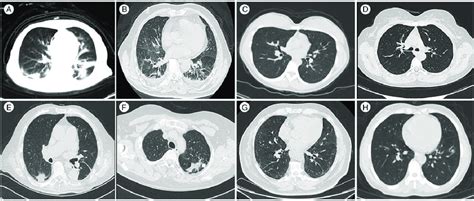 Chest Ct Scans For All 8 Patients A And B Case 1 And 2 Had Bilateral