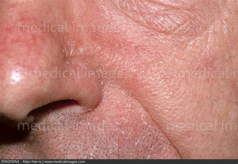 Stock Image Dermatology Seborrheic Dermatitis Dry Red And Inflamed