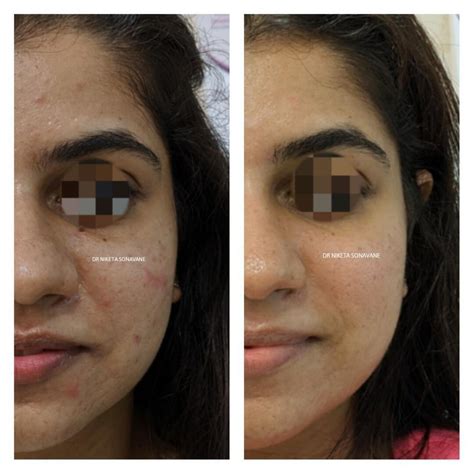 Dermatologist In Mumbai Skin Treatment Before And After Photos