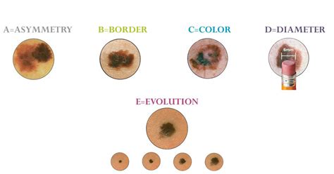 How To Tell A Mole From Melanoma Aim At Melanoma Foundation