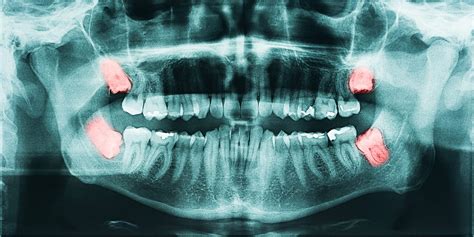 Dental Tooth X Ray Visualize Diseases Of Impacted Wisdom Teeth