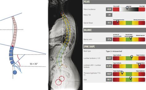 6 Spinal Curves Segmentation And Lumbar Lordosis Classification