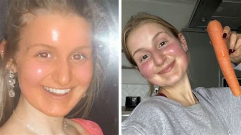 Edinburgh Womans Skin Turned Bright Orange Like Oompa Loompa After
