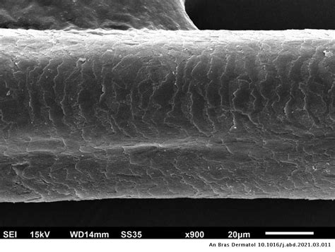 Scanning Electron Microscopy Of Panitumumab Induced Eyelash And Hair