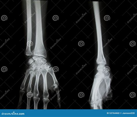 X Ray Of Both Human Arms Stock Photo Image Of Anatomy 53764460