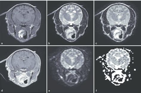 Mri Appearance Of Thalamic Ischemic Stroke A Focal Lesion Is Present