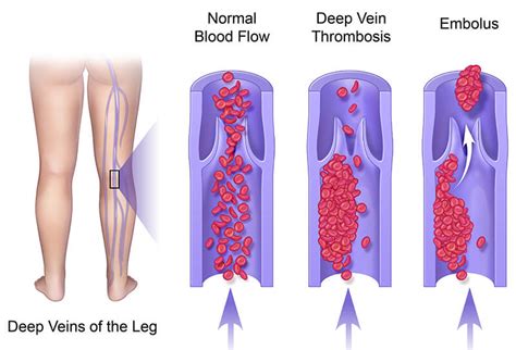 Deep Vein Thrombosis Blood Clot In Legs Sexiz Pix