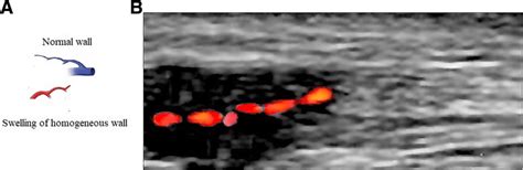 Ultrasound Image Of The Temporal Artery Wall A Pictorial Presentation