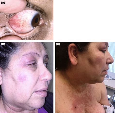 Periorbital Swelling And Episcleritis May Be A Sign Of Cutaneous Lupus