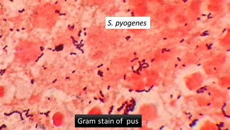 Yoh Streptococcus Pyogenes Gram Stain Images And Photos Finder