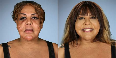 Top 10 Botched Plastic Surgery Fails Before And After Photos In 2020