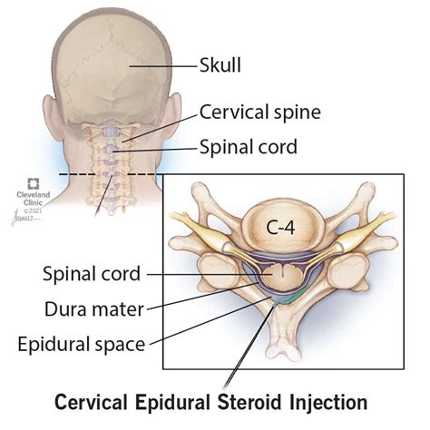 Cervical Epidural Steroid Injection New South Medical