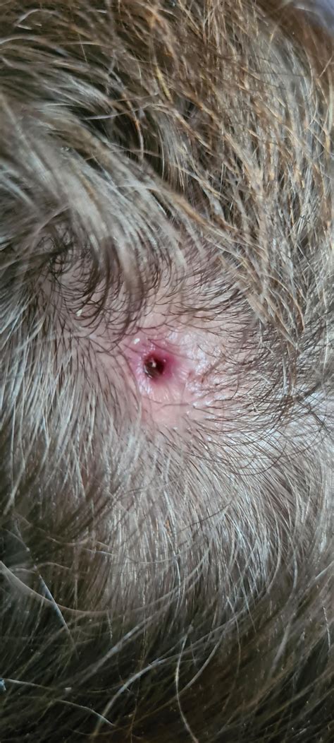 20 Year Old Cyst Popped Doc Put Plastic Piece In To Drain Puss And Now