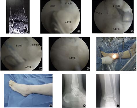 Arthroscopic Anatomical Repair Of Anterior Talofibular Ligament For