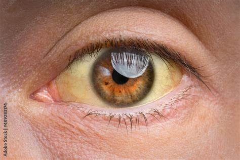 Foto De Closeup Of Yellow Eye Because Of High Bilirubin Level
