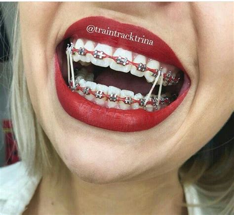 Pin By La Garden On Ari ️ Dental Braces Cute Braces Colors Teeth Braces