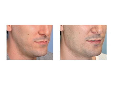 Blog Archivecase Study Vertical Lengthening Jaw Angle Implants