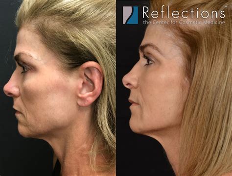 NonSurgical Facelift With Thread Lift Fillers Before After Photos