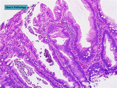 Qiao S Pathology Sessile Serrated Adenoma Of Right Colon Flickr