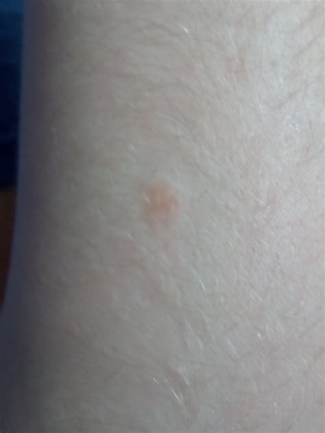 Spot On Arm Dermatologyquestions