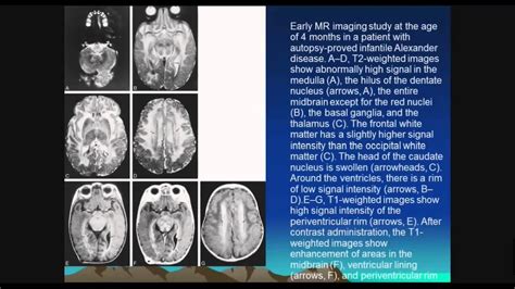 The leukoaraiosis and disability (ladis) is a multicenter collaboration evaluating the independent role of white matter change by neuroimaging in determining disability in many clinical aspects, such as functional status, cognition, mood, motor performances, and urinary problems. White matter diseases, - YouTube