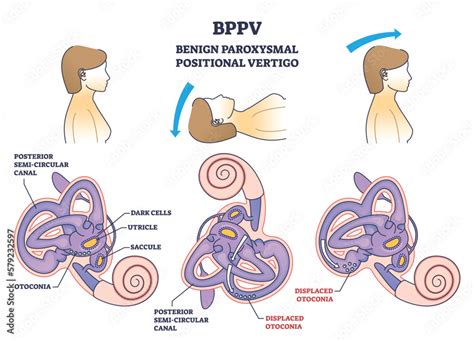 Vetor De Bppv Or Benign Paroxysmal Positional Vertigo Syndrome Outline Diagram Labeled