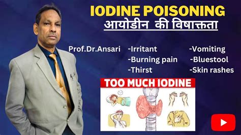 Iodine Poisoning Irritant Burning Pain Thirst Vomiting