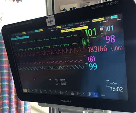 What Do The Numbers On A Hospital Monitor Mean Medical Blog